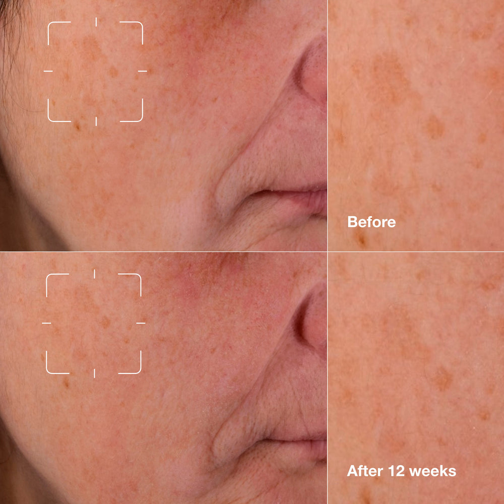 Even Better Clinical™ Dark Spot Clearing Serum