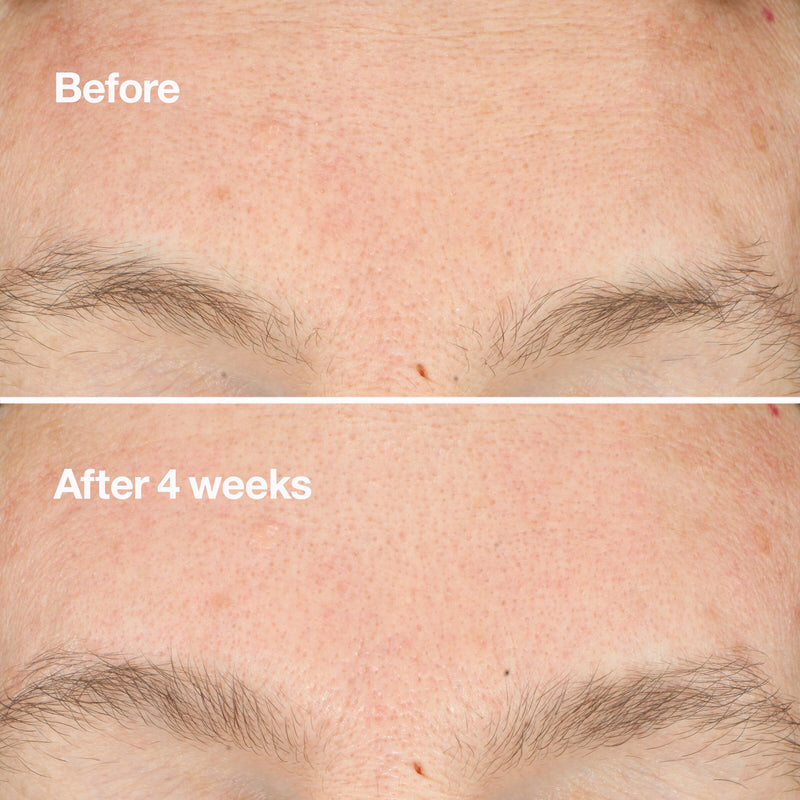 Clarifying Do-Over Peel