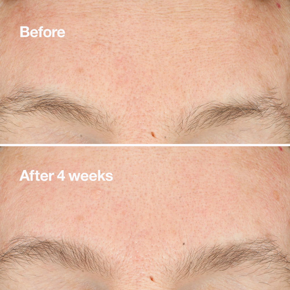 Clarifying Do-Over Peel
