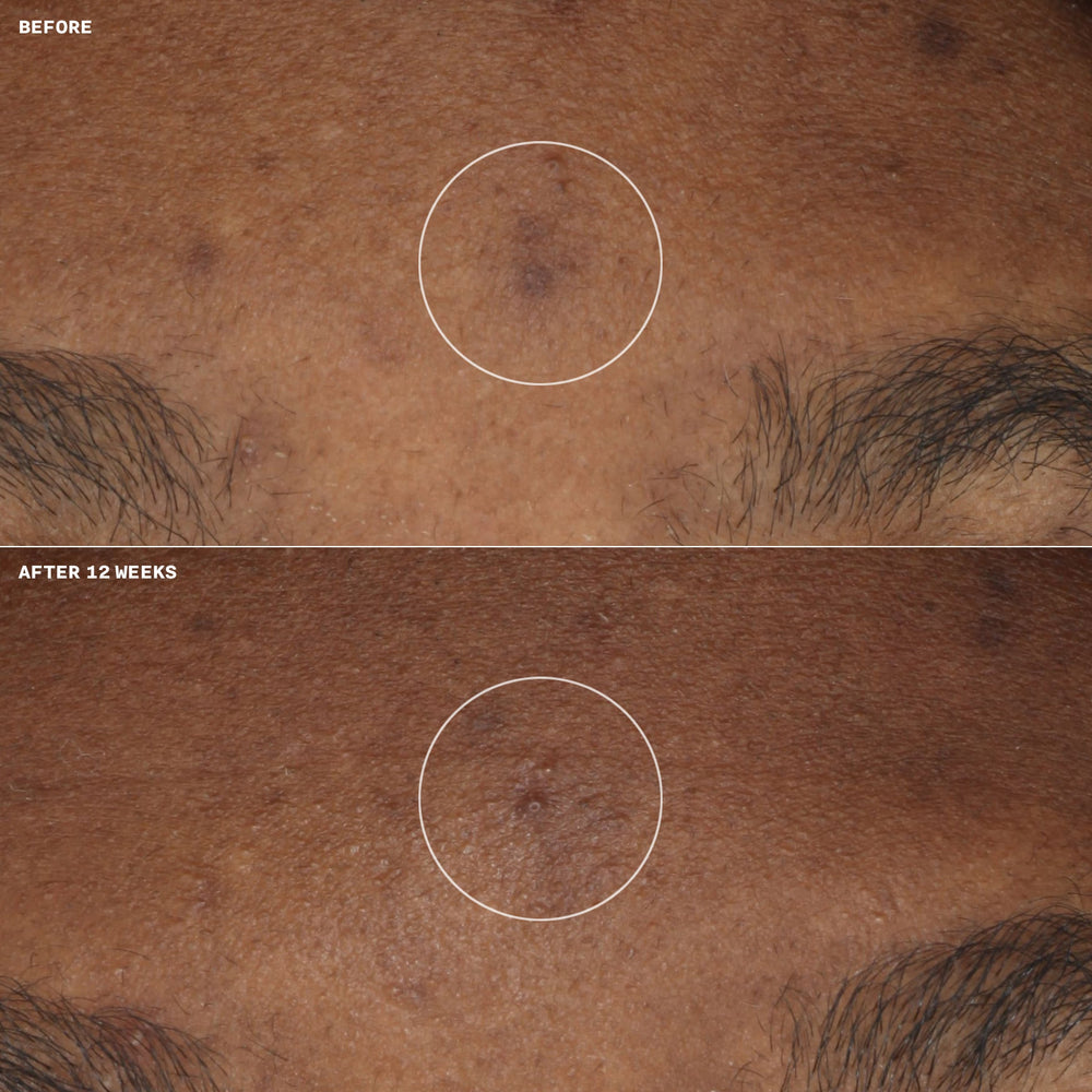 Even Better Clinical™ Brightening Moisturizer
