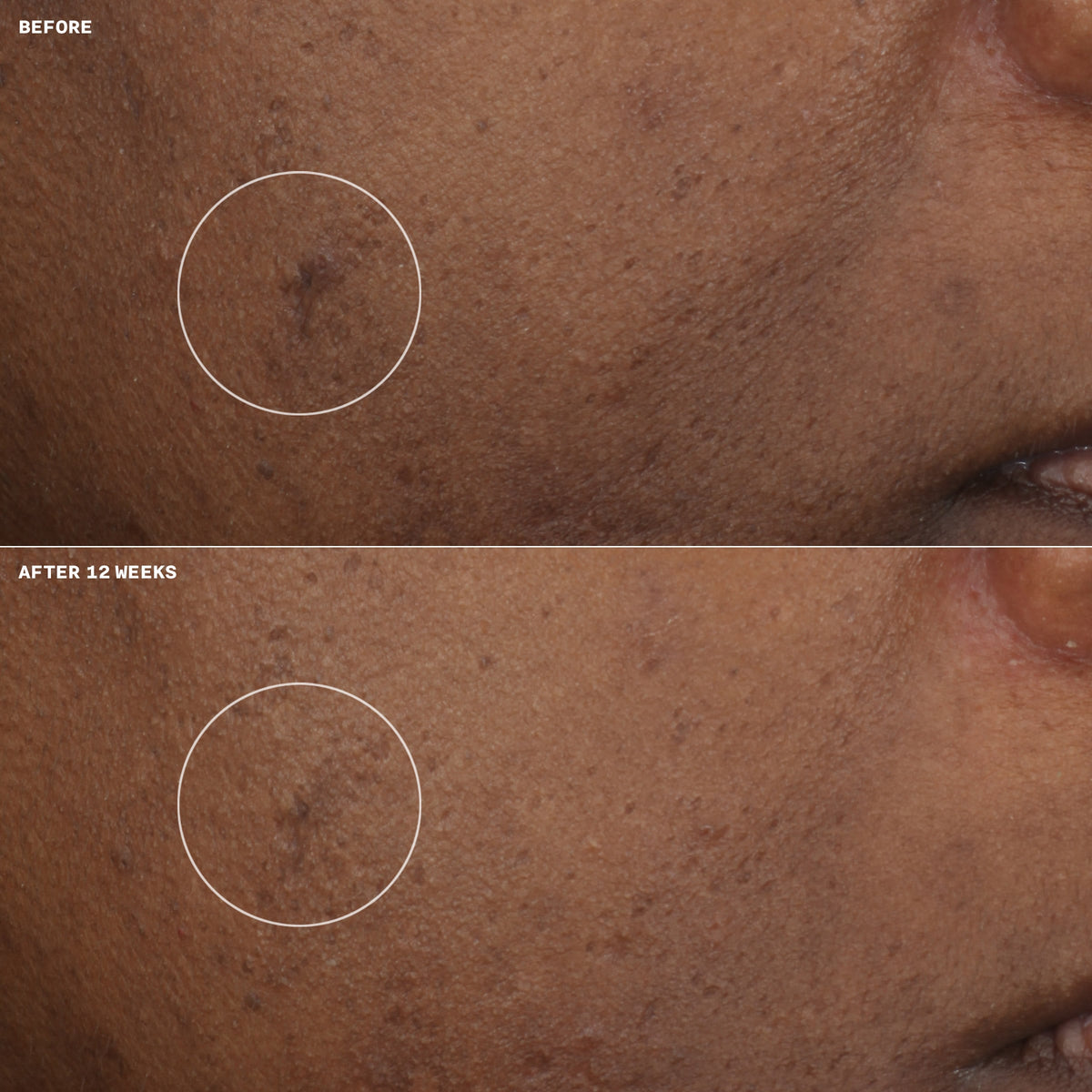 Even Better Clinical™ Brightening Moisturizer