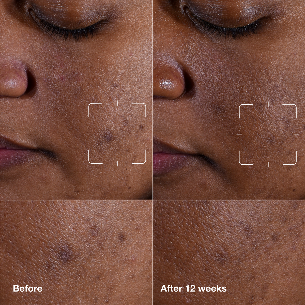 Even Better Clinical™ Dark Spot Clearing Serum