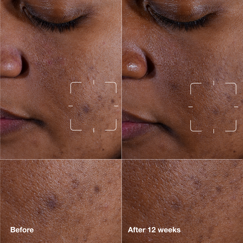 Even Better Clinical™ Dark Spot Clearing Serum