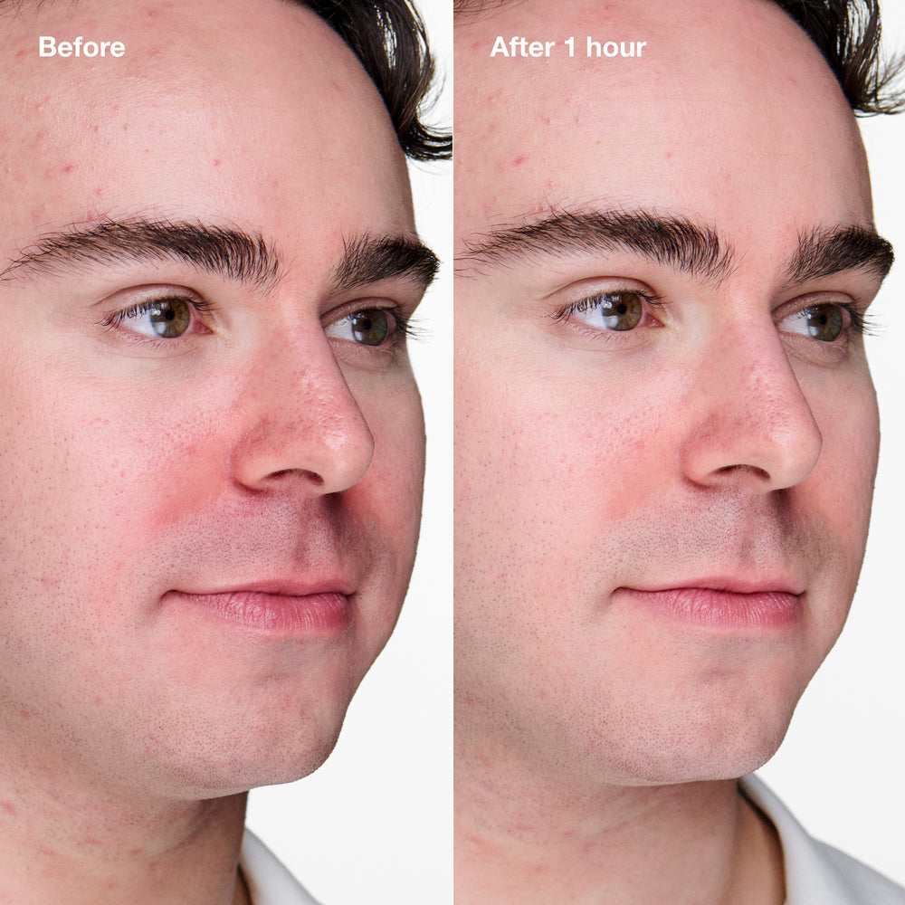 Acne Solutions Clinical™ Advanced Clearing Gel