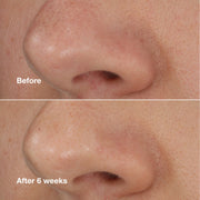 Blackhead Solutions Blackhead Solutions Self-Heating Blackhead Extractor