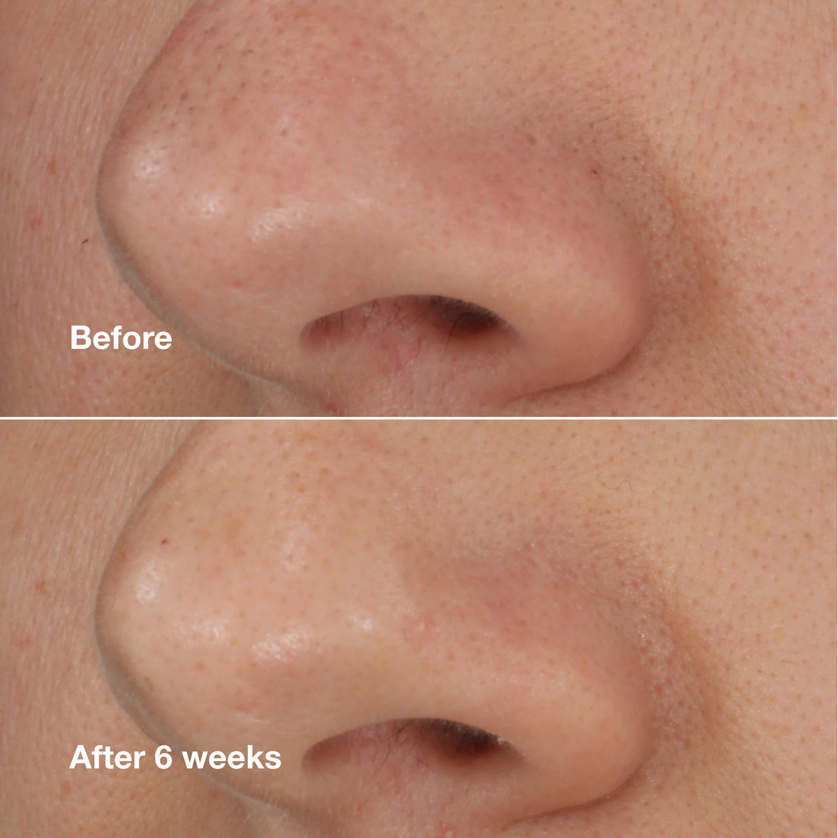 Blackhead Solutions Blackhead Solutions Self-Heating Blackhead Extractor