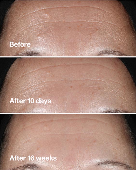 Before. After 10 days. After 16 weeks.
